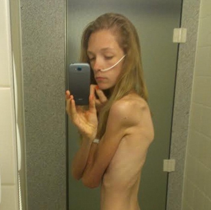 Anorexic Sluts